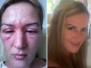 Žena (42) dostala alergiu