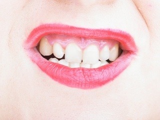 Krvácajúce ďasná sú zlým