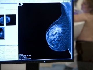Mamografické vyšetrenie niektorí považujú