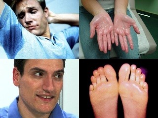 Nadmerné potenie je choroba,