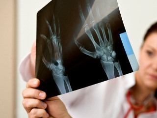 O osteoporóze mnohí odborníci