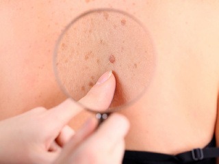 Výskyt melanómu sa oproti