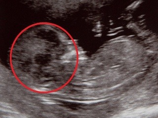 Strašidelný detail na ultrazvuku: