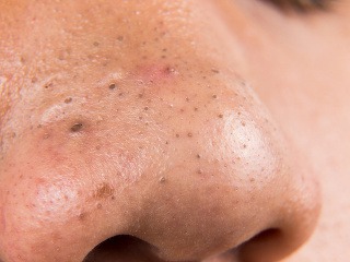 Čierne bodky sú nepríjemné,