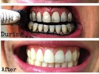 Domáce bielenia zubov?