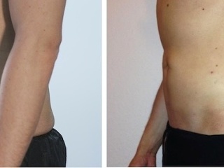 Libor Komosný pred a 2 mesiace po zákroku spodnej časti brucha a bokov metódou Vaser lipo. 