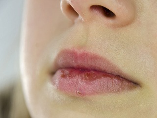 Popraskané pery sa môžu