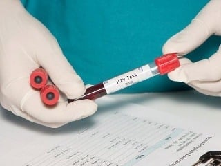 Prípadov HIV infekcie pribúda