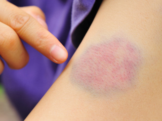 Na akné zaberá citrónová