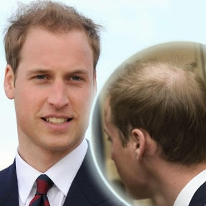 Princ William: Plešina namiesto
