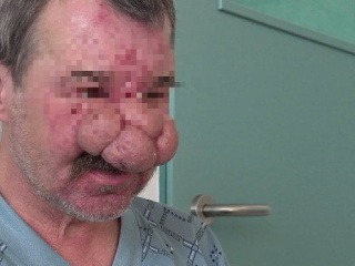 Tibor (52) kvôli nosu