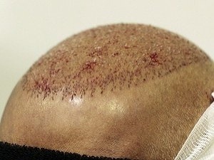 Lacná transplantácia vlasov: Najrýchlejšie