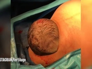 „Prirodzený“ cisársky rez v