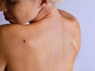 Sledujete tvar svojich znamienok?