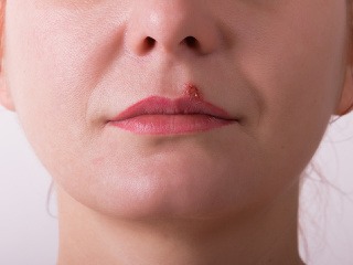 Nepríjemné herpesy: Čo ich