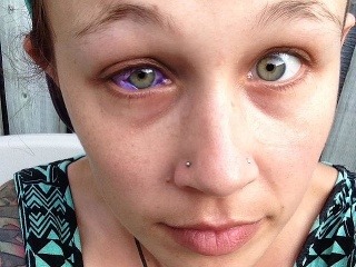 Tetovanie oka zničilo život