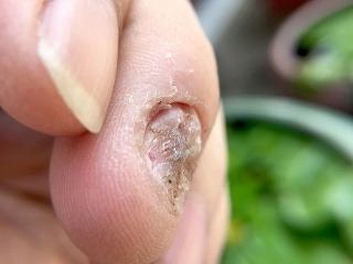 Slováci psoriázu veľakrát ignorujú: