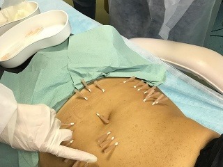 Mezoterapia a chemický peeling