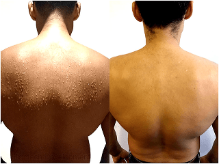 Silné potenie v zime?