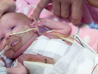 Dieťa sa narodilo bez