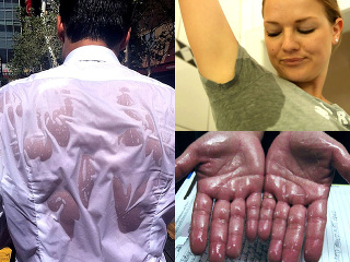 Trpíte nadmerným potením? Usušíme