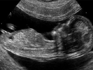 Určite si pohlavie bábätka