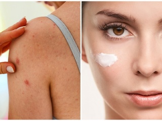 Alergická reakcia na kozmetiku