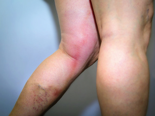 Trombóza môže prekvapiť aj