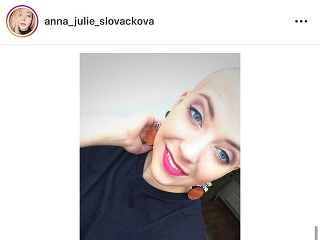 Anička Slováčková kvôli krutej diagnóze prišla o vlasy.