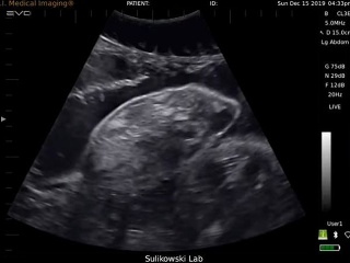 Neuveriteľný tehotenský ultrazvuk: VIDEO