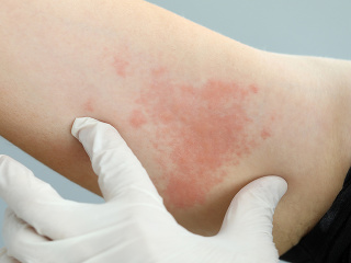 Zvláštny PRÍZNAK koronavírusu: Ak