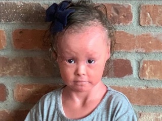 Koža malej Harper sa