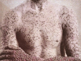 Smrteľnými kiahňami sa nakazilo