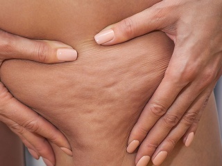 Chcete sa zbaviť celulitídy