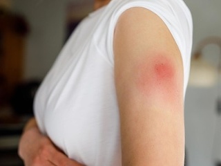 NEŽIADÚCE reakcie po podaní