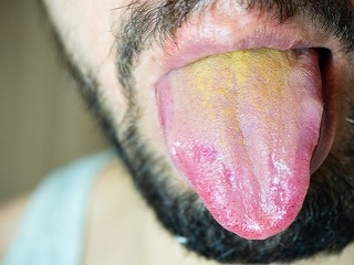 Farba JAZYKA ako predzvesť