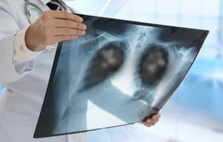 Rakovina pľúc postihuje aj