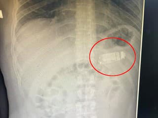 Väzeň prehltol Nokiu 3310: