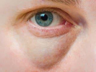 MENEJ známe príčiny vzniku