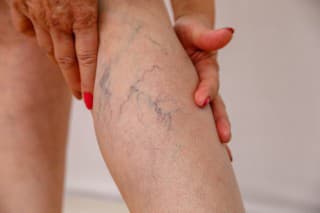 Kardiológ radí: Ako predchádzať