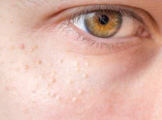 Tieto VYRÁŽKY zmiznú až