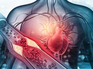 Ako sa vysoký CHOLESTEROL