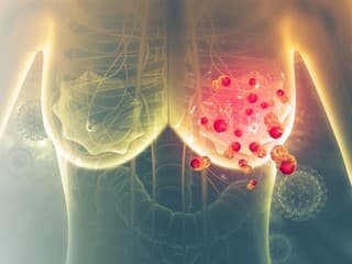 Rakovina prsníka je NAJAGRESÍVNEJŠIA