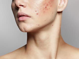 HORMÓNY môžu rozhádzať celé