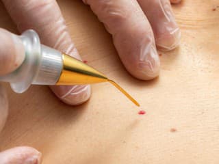 LETO nie je PREKÁŽKOU: