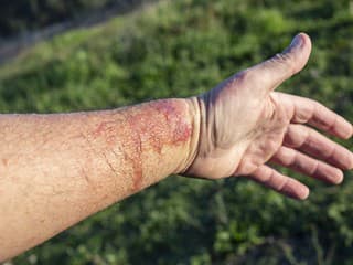 SKRÝVA sa za SPÁLENÍM