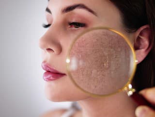 Trápia vás ružové škvrny