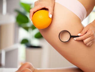 Trápi vás celulitída? Dajte