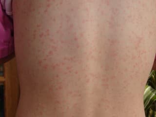 POZOR Na tele bábätka