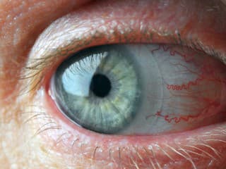Lekárku šokoval prípad pacientky: V oku mala vyše dvadsať kontaktných šošoviek! Hrôzostrašné VIDEO